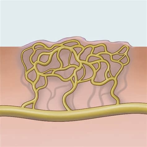 Lymphatic Malformation Lm Johns Hopkins Medicine Health Library