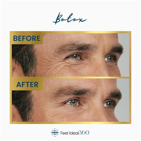 Botox Injections Before And After Feel Ideal 360 Med Spa Southlake Tx
