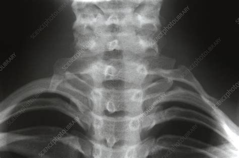 Cervical Ribs X Ray Stock Image M3500371 Science Photo Library