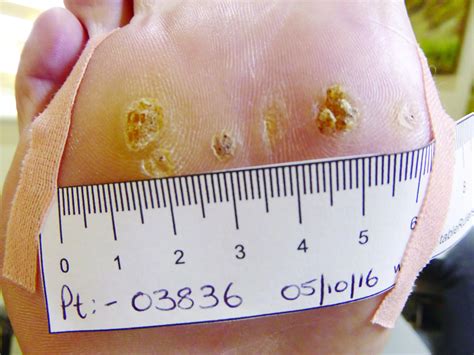 The Best Way To Treat Warts