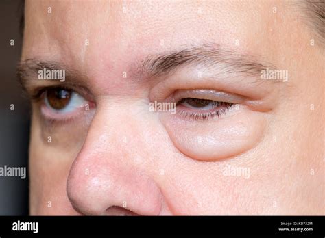 Inflammation Of The Eyelid Swelling Of The Eye After Insect Bite A