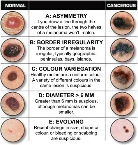 Benign Tumor Skin