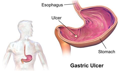 Understanding Gi Disorders Gerd Gastritis Peptic Ulcer Disease
