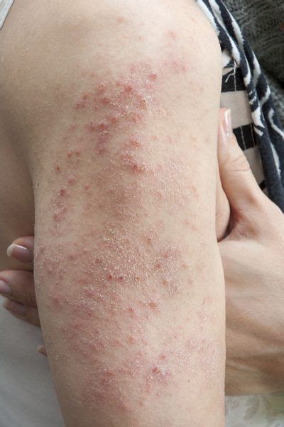 Viruses That Cause Skin Rashes Dermatitis Herpetiformis Food Allergy