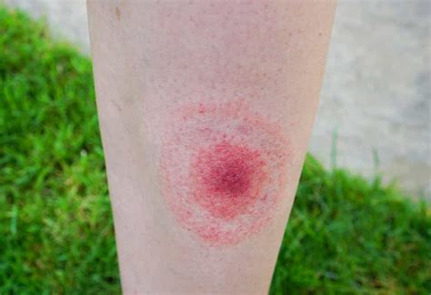Everything You Need To Know About Lyme Disease Overview Causes Types