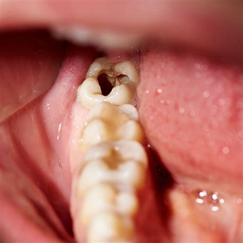 Gentle Tooth Extraction Victoria Tx Gulf Coast Periodontics