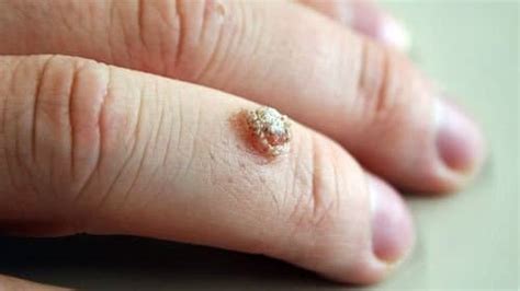 Warts And All What You Need To Know About Warts CTD