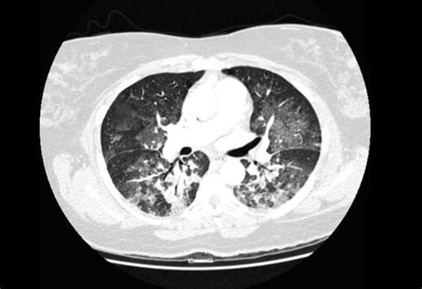 Pulmonary Edema Ct Wikidoc