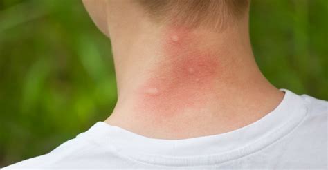 What Are The Signs Of A Dangerous Bug Bite Passport Health