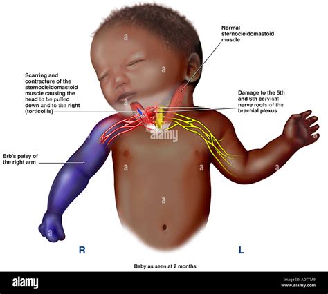 Brachial Plexus Injury Infant