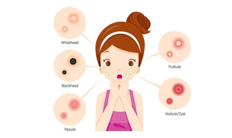 Acne Treatments Different Types Of Pimples How To Treat Them