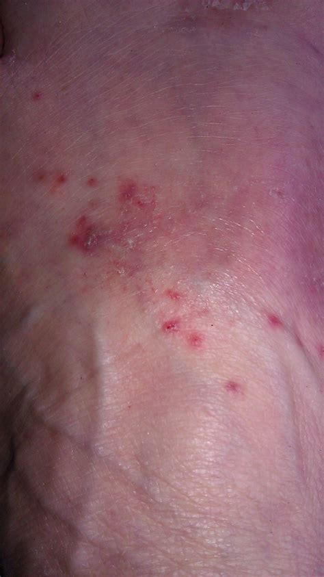 Penile Papules And Herpes