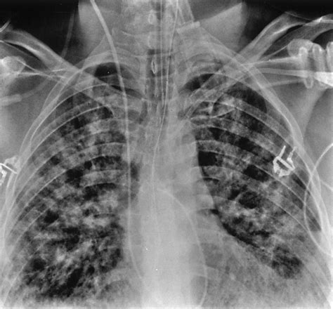 Clinical And Radiologic Features Of Pulmonary Edema Radiographics