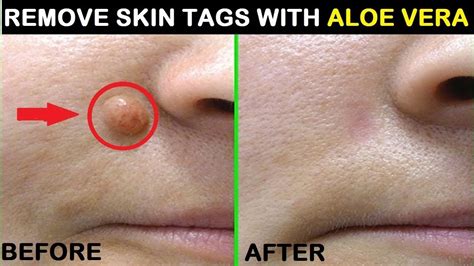 7 home remedies to remove skin tags in 18 minutes get rid of skin tags at home video