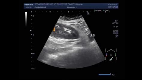 Ultrasound Video Showing An Ectopic Kidney With A Renal And Ureteral