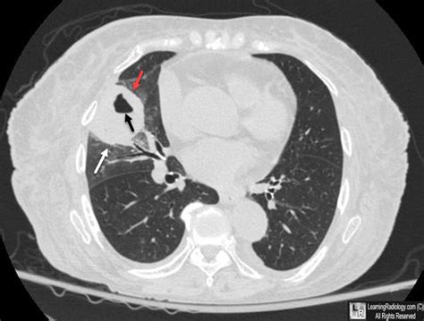 Learningradiology Lung Abscess Pulmonary