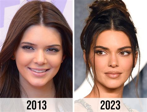 Fans React To Early Kendall Jenner Photos After Rumored Plastic Surgery