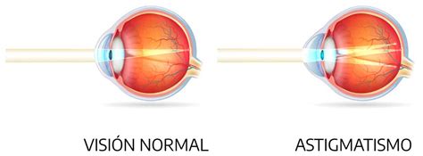 Astigmatismo Qu Es Y C Mo Se Trata Rea Oftalmol Gica Avanzada