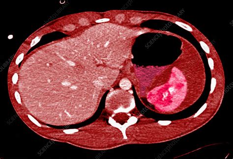 Fractured Spleen Ct Scan Stock Image C0353589 Science Photo Library