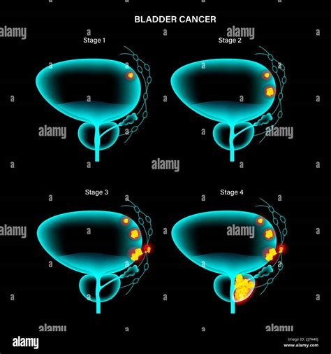Bladder Cancer Stages Illustration Stock Photo Alamy
