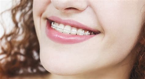 Ceramic Braces Vs Metal Braces Plus Costs And Faqs Ask The Dentist