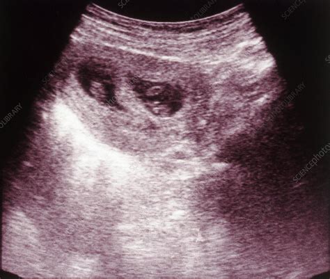 Ultrasounds At 8 Weeks