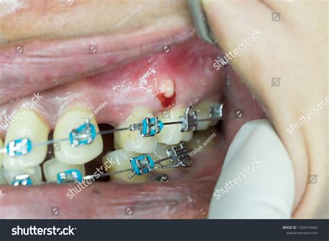 Gingival Abscess Orthodontic Mini Screw Infection Stock Photo Edit Now