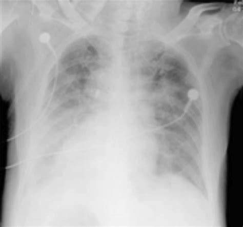 Chest Radiograph Taken Day 4 Displaying Bilateral Exudative Lesions And