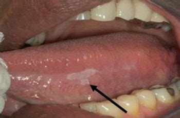 What does mouth cancer look like. Stages Of Tongue Cancer - Cancer News Update