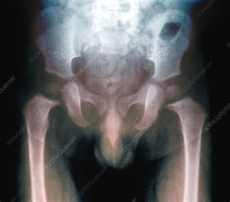 Hip Deformity Due To Rickets X Ray Stock Image C0577311 Science