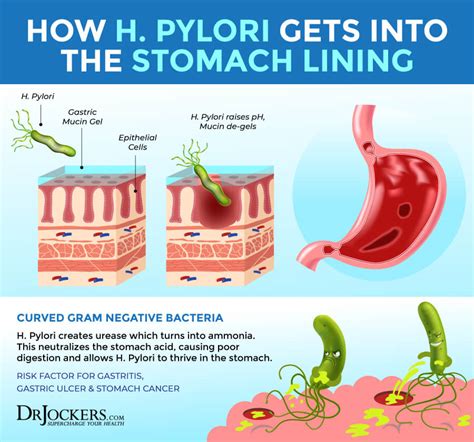 H Pylori Protocol Diet And Herbal Strategies