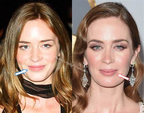 Emily Blunt Plastic Surgery Before And After With Pic Vrogue Co