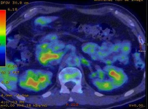 Fdg Pet Imaging Showing Avid Uptake In The Kidneys And Cbd In A Patient