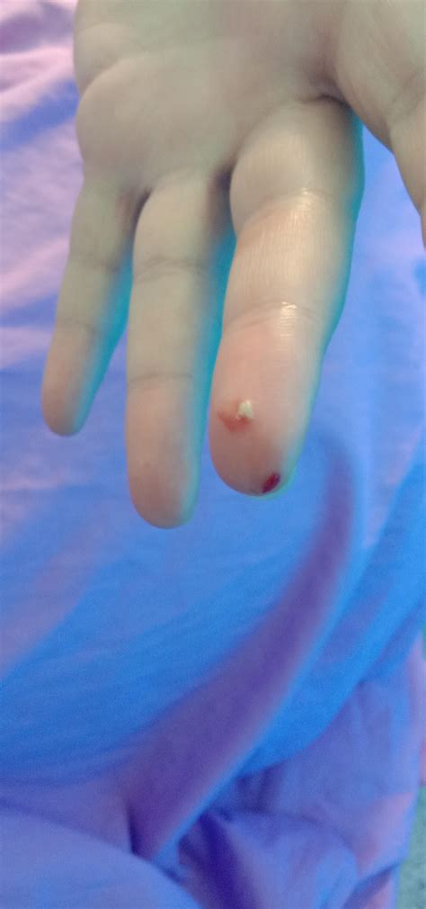 My Girlfriend popped a pimple on the side of her nose and this was the