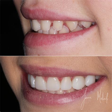 View Teeth Before Veneers  Teeth Walls Collection For Everyone