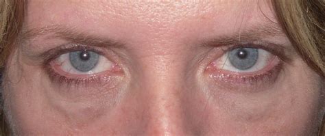 Swelling Swelling Under One Eye