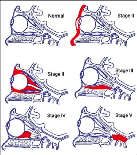 Stages Of Oculo Orbital Complications Of Rhinosinusitis Download