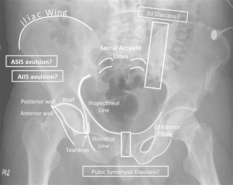 Key Radiological Landmarks For Pelvic Fractures On A Pelvic X Ray