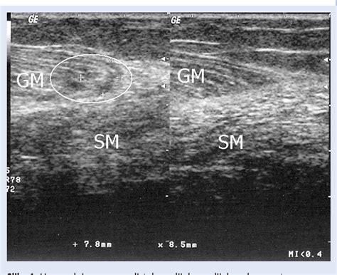 Place your hands on the floor in front of you. Figure 1 from Rupture of the medial gastrocnemius head (Tennis leg) - connection between ...