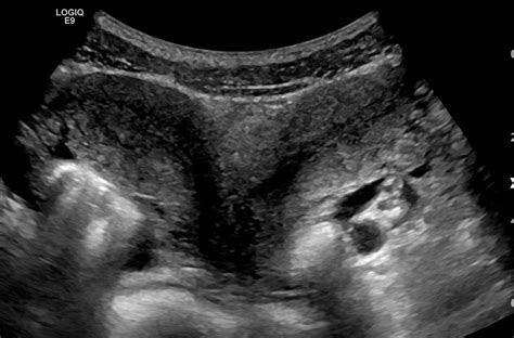 Диделфис на матката или как една жена може да се роди с две вагини