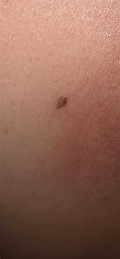 Is This Mole Worth Going To The Dermatologist For Half Size Of A End