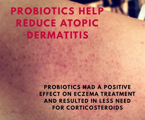 Probiotics Help Reduce Atopic Dermatitis Botanica Media