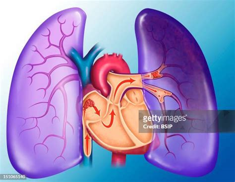 Pulmonary Embolism Photos And Premium High Res Pictures Getty Images