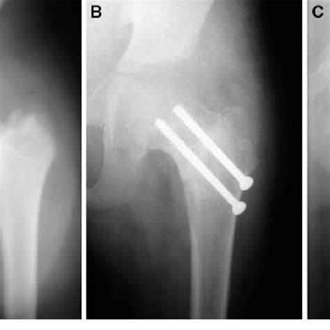 A Anteroposterior Radiograph Preoperative Of Pelvis With Both Hips