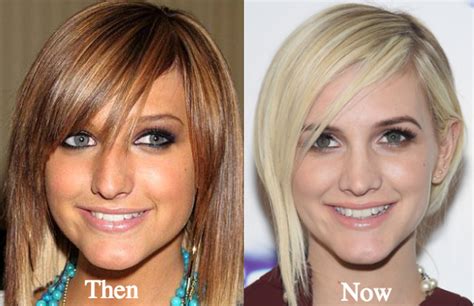 Ashlee Simpson Plastic Surgery Before And After Photos