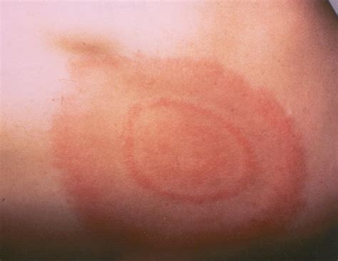 Beware Lyme Disease Is Looming Skincare Physicians