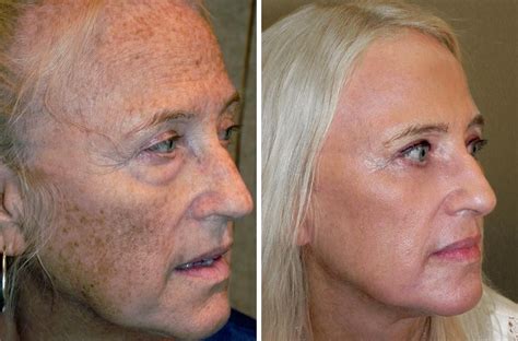 Reverse Facial Sun Damage With Dr Scheiners Reset For Sun Damage