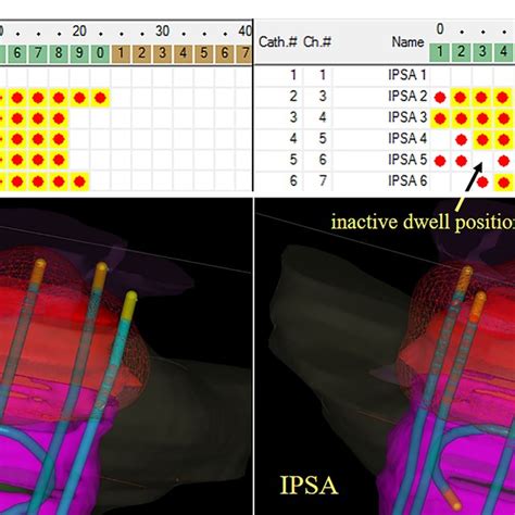 The Active Dwell Positions In The Intracavitary Applicator And In The