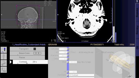 Ct Scan Of Brain With Contrast Full Work Siemens Youtube