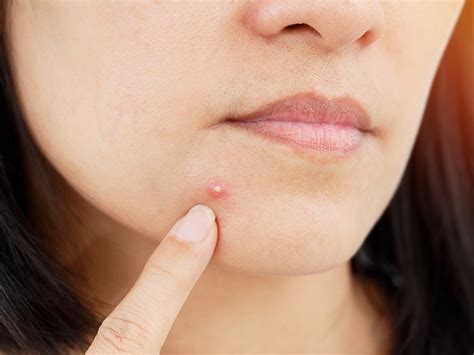 Blind Pimple A Blind Zit Refers To Acne That S Grown Under Your Skin